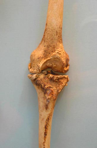 Fig. 14. Artritis de rodilla de un anciano. Período Meroítico, (Gabati) Sudán. Tumba 36. British Museum. (Foto del autor).